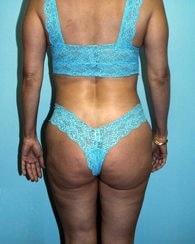Jhonny A. Salomon Plastic Surgery & Med Spa liposuction after — Miami, FL