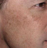 Laser Skin Resurfacing before at Jhonny A. Salomon Plastic Surgery & Med Spa in Miami, FL