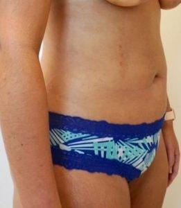 Jhonny A. Salomon Plastic Surgery & Med Spa liposuction after — Miami, FL