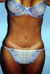 Jhonny A. Salomon Plastic Surgery & Med Spa tummy tuck after — Miami, FL