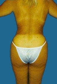 Jhonny A. Salomon Plastic Surgery & Med Spa liposuction after — Miami, FL