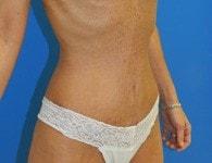 Jhonny A. Salomon Plastic Surgery & Med Spa tummy tuck after — Miami, FL