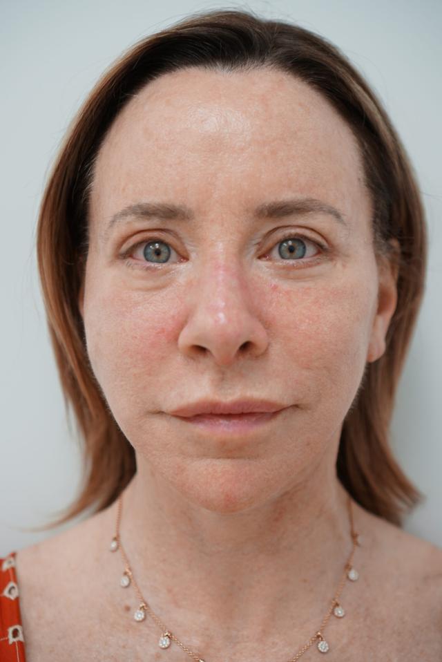 Brow Lift after at Jhonny A. Salomon Plastic Surgery & Med Spa in Miami, FL