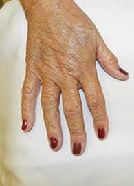 Jhonny A. Salomon Plastic Surgery & Med Spa fat transfer after — Miami, FL
