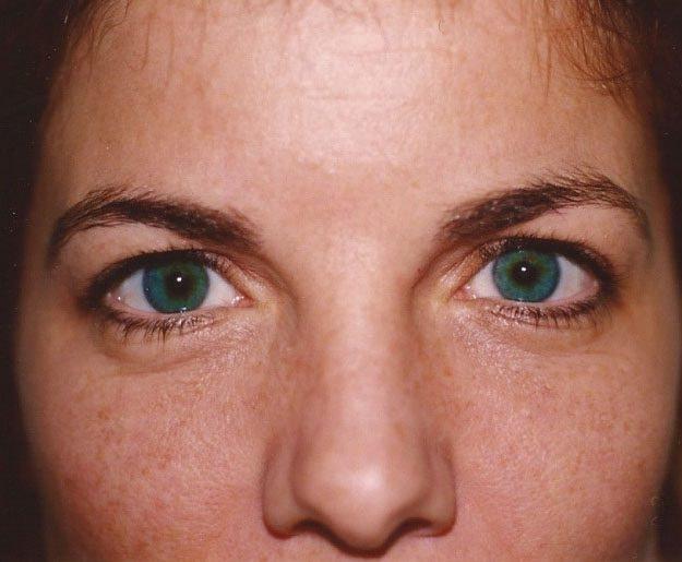 Brow Lift before at Weston Cosmetic Surgery in Weston, FL