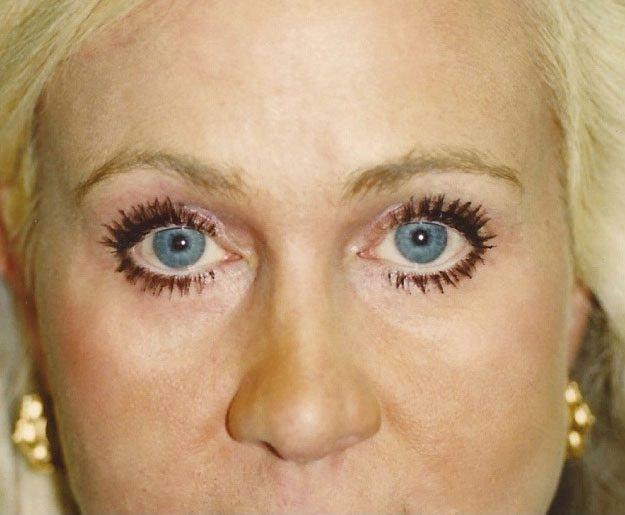 Weston Cosmetic Surgery brow lift after — Weston, FL