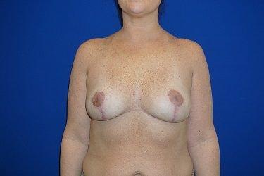 Weston Cosmetic Surgery breast implant removal after — Weston, FL