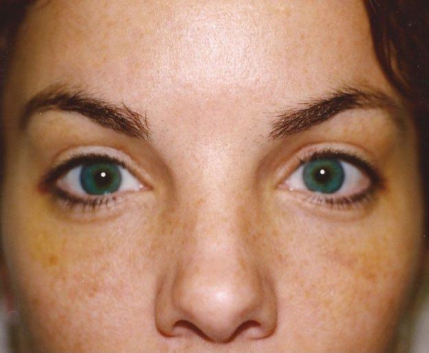 Weston Cosmetic Surgery brow lift after — Weston, FL