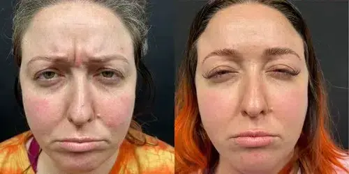 Botox result at Georgous Aesthetic Bar in Kansas City, MO