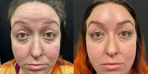 Georgous Aesthetic Bar botox result — Kansas City, MO