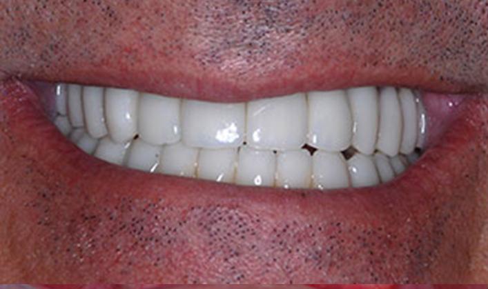 OC Dental Specialists | Emergency & Cosmetic Dentist Irvine smile makeover after — Irvine, CA