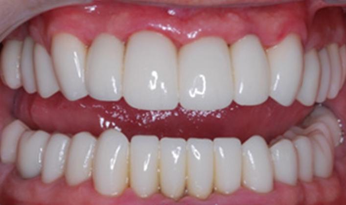 OC Dental Specialists | Emergency & Cosmetic Dentist Irvine smile makeover after — Irvine, CA