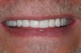 OC Dental Specialists | Emergency & Cosmetic Dentist Irvine smile makeover after — Irvine, CA
