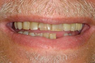 Smile Makeover before at OC Dental Specialists | Emergency & Cosmetic Dentist Irvine in Irvine, CA