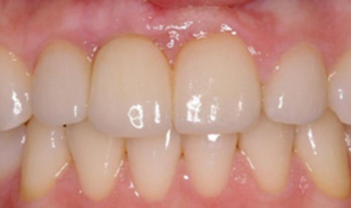 OC Dental Specialists | Emergency & Cosmetic Dentist Irvine smile makeover after — Irvine, CA