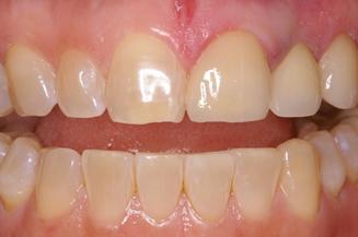 Smile Makeover after at OC Dental Specialists | Emergency & Cosmetic Dentist Irvine in Irvine, CA