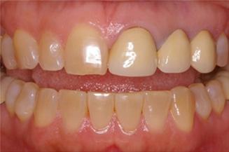 Smile Makeover before at OC Dental Specialists | Emergency & Cosmetic Dentist Irvine in Irvine, CA