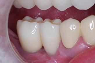 OC Dental Specialists | Emergency & Cosmetic Dentist Irvine smile makeover after — Irvine, CA