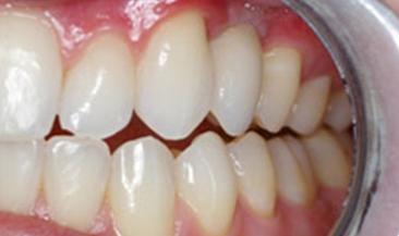 OC Dental Specialists | Emergency & Cosmetic Dentist Irvine smile makeover after — Irvine, CA