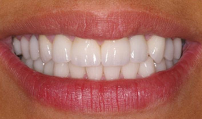 OC Dental Specialists | Emergency & Cosmetic Dentist Irvine smile makeover after — Irvine, CA