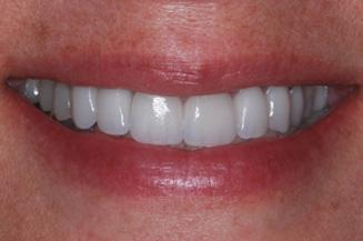 OC Dental Specialists | Emergency & Cosmetic Dentist Irvine smile makeover after — Irvine, CA