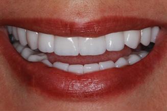 Smile Makeover after at OC Dental Specialists | Emergency & Cosmetic Dentist Irvine in Irvine, CA