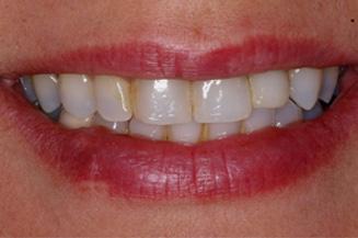 Smile Makeover before at OC Dental Specialists | Emergency & Cosmetic Dentist Irvine in Irvine, CA