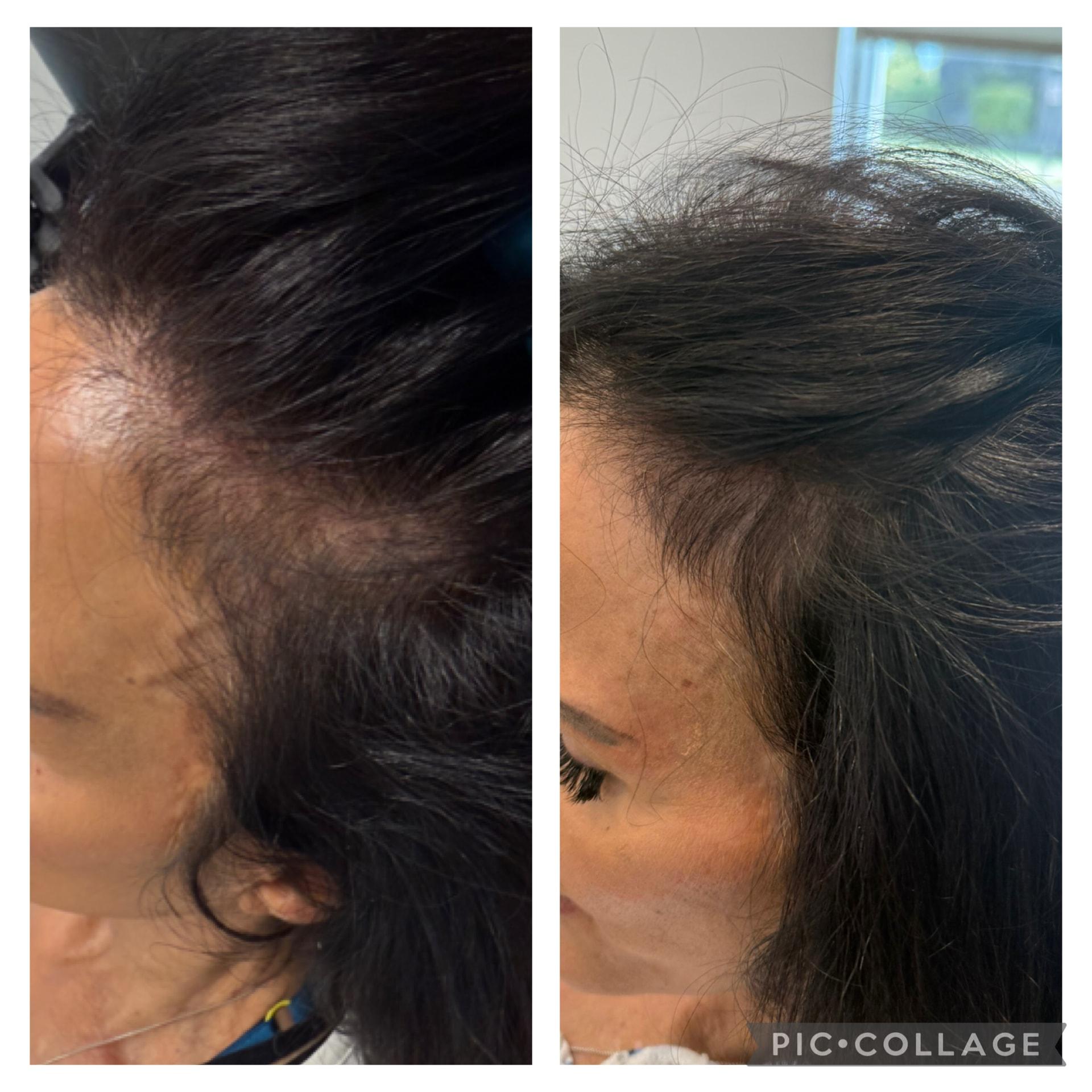 Arlani Integrative Medicine and Medspa hair restoration result — Murray, UT