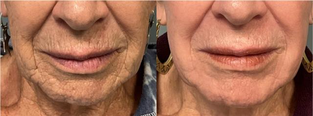 Laser Skin Resurfacing result at Arlani Integrative Medicine and Medspa in Murray, UT