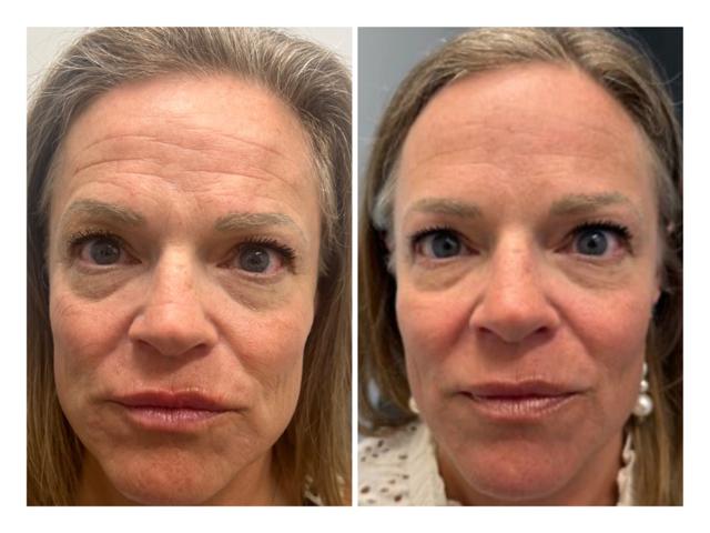 Laser Skin Resurfacing result at Arlani Integrative Medicine and Medspa in Murray, UT