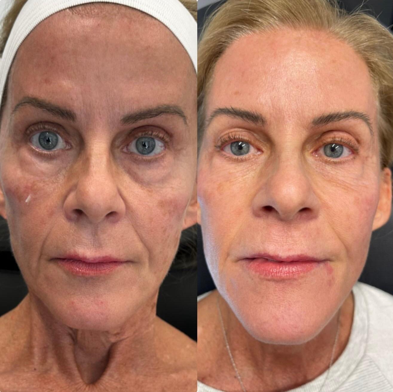 Arlani Integrative Medicine and Medspa laser treatment result — Murray, UT