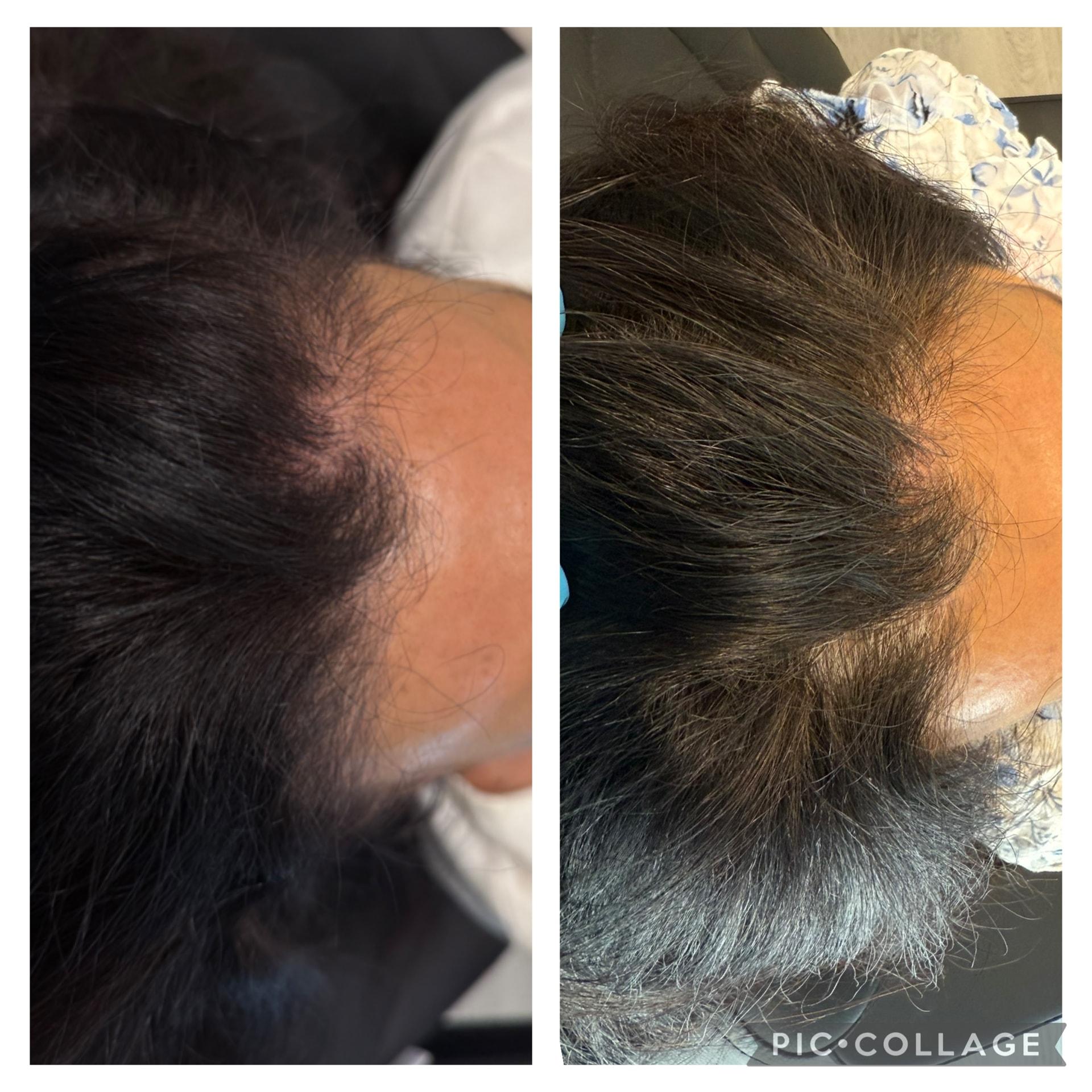 Arlani Integrative Medicine and Medspa hair restoration result — Murray, UT