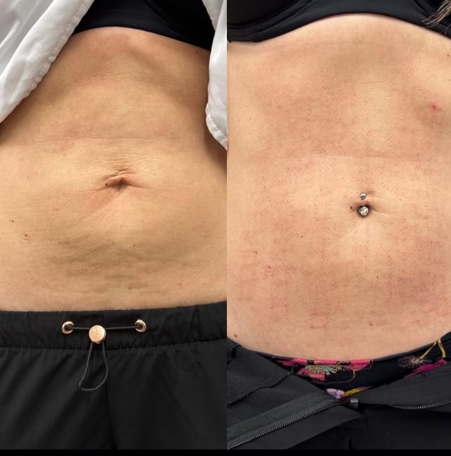 Morpheus8 result at Arlani Integrative Medicine and Medspa in Murray, UT