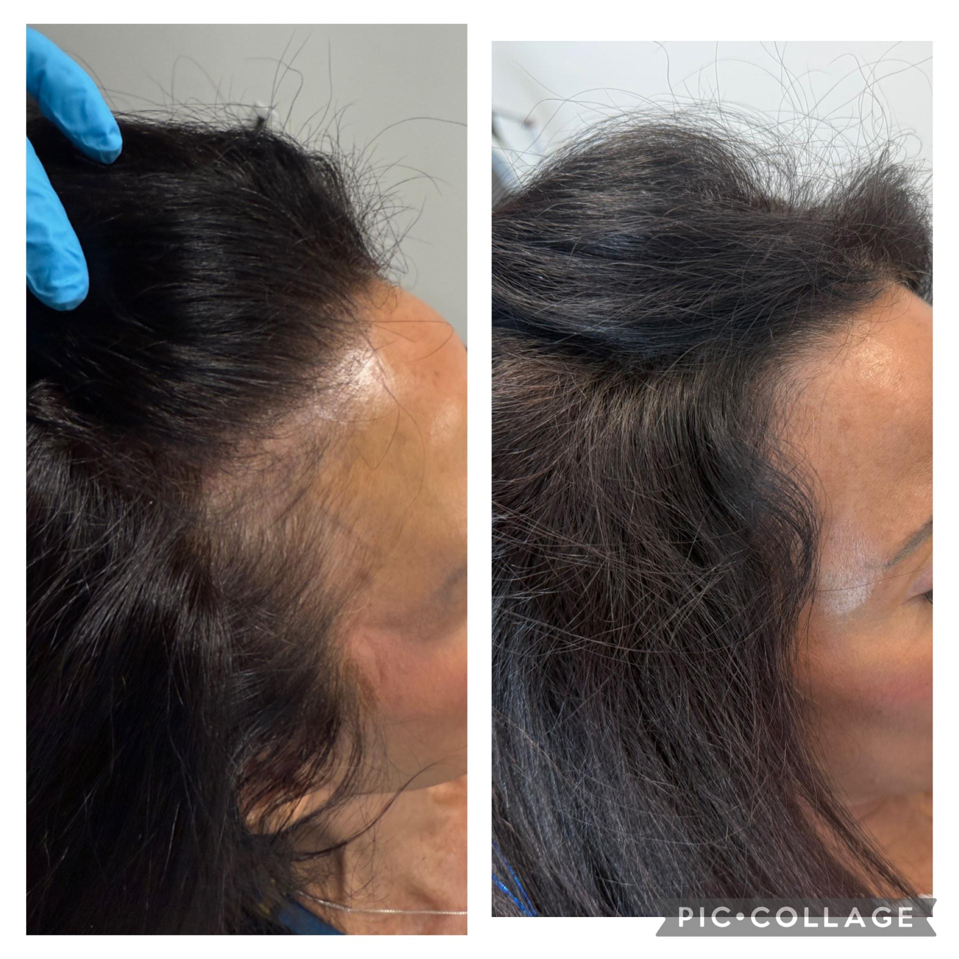 Arlani Integrative Medicine and Medspa hair restoration result — Murray, UT