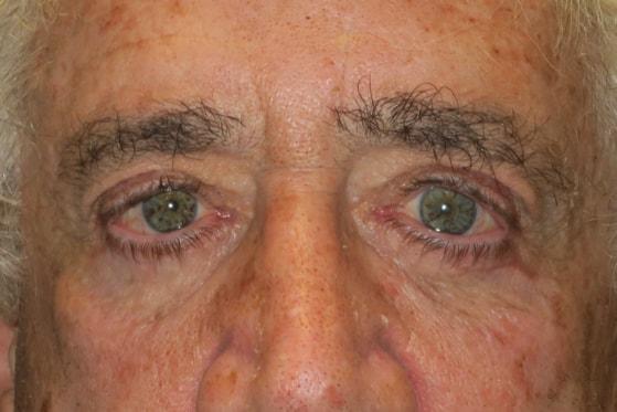Brow Lift after at NAVA Face & Eye in Nampa, ID