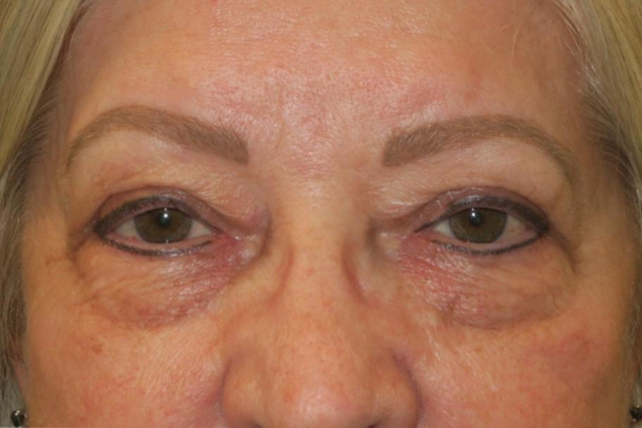 NAVA Face & Eye eyelid lift after — Nampa, ID
