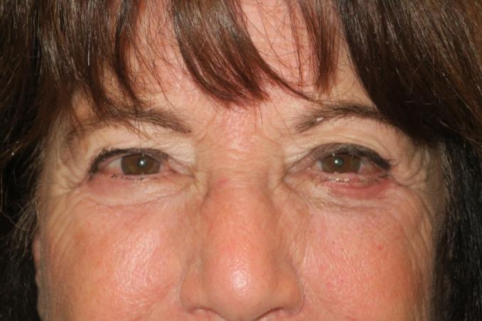 NAVA Face & Eye eyelid lift after — Nampa, ID