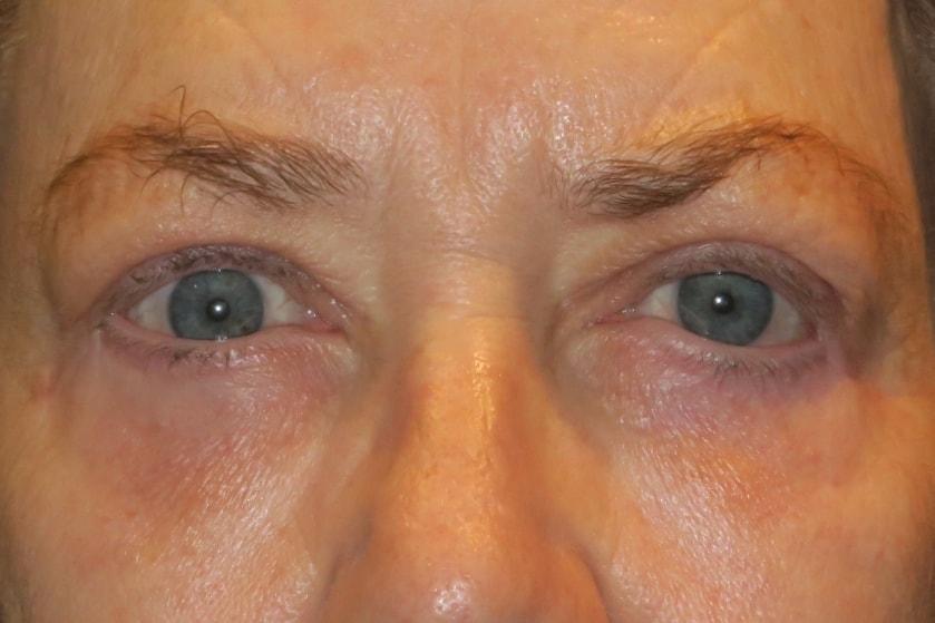 NAVA Face & Eye eyelid lift after — Nampa, ID