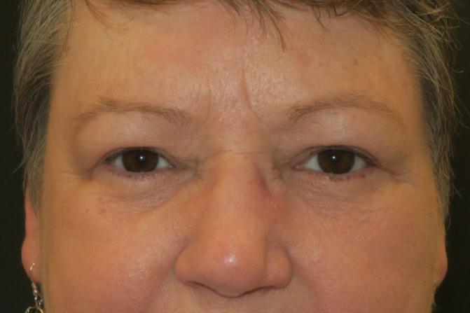 NAVA Face & Eye eyelid lift after — Nampa, ID