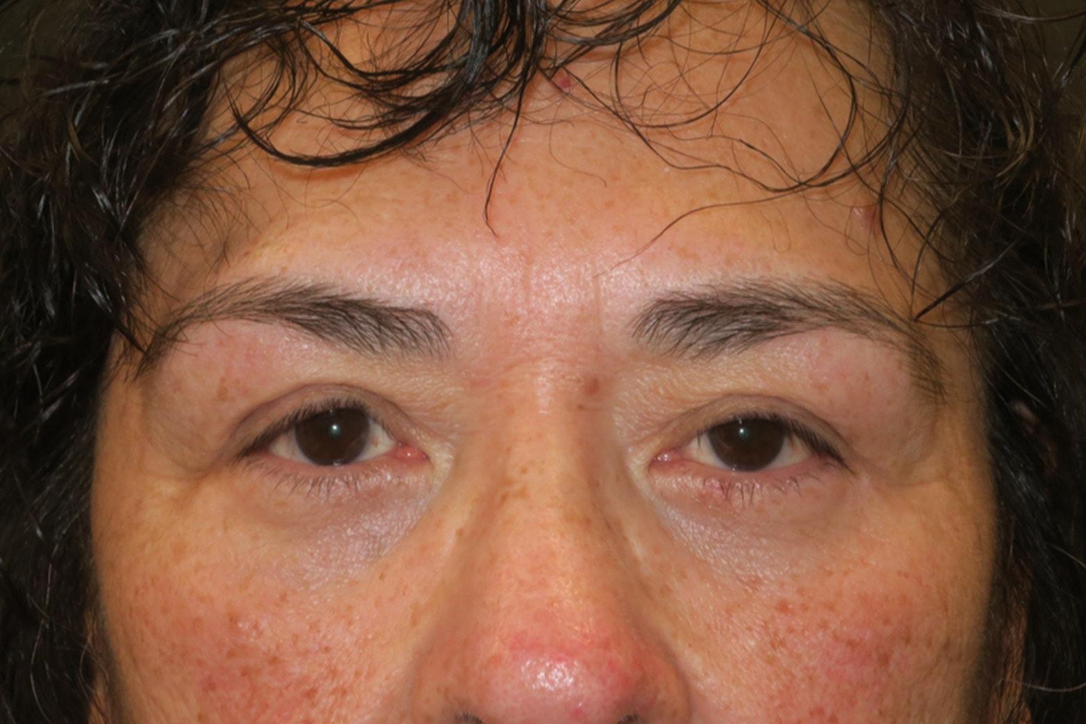 NAVA Face & Eye eyelid lift after — Nampa, ID