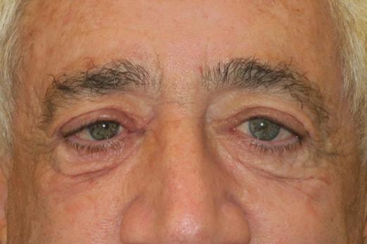 Brow Lift before at NAVA Face & Eye in Nampa, ID