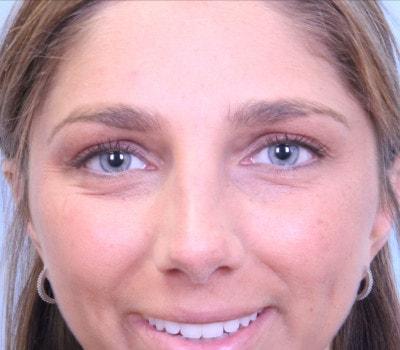 Sasson Plastic Surgery rhinoplasty after — Great Neck, NY