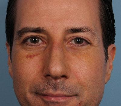 Sasson Plastic Surgery rhinoplasty after — Great Neck, NY