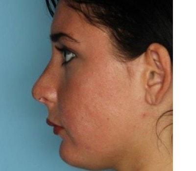 Sasson Plastic Surgery rhinoplasty after — Great Neck, NY