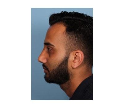 Sasson Plastic Surgery rhinoplasty after — Great Neck, NY