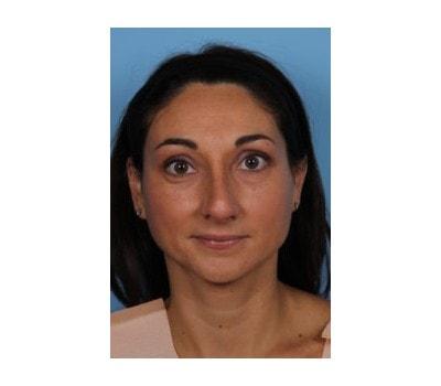 Sasson Plastic Surgery rhinoplasty after — Great Neck, NY