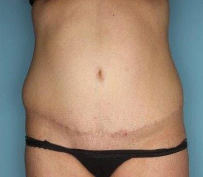 Sasson Plastic Surgery tummy tuck after — Great Neck, NY