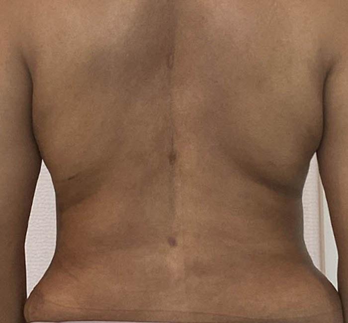 New You Plastic Surgery liposuction after — Roslyn, NY