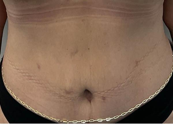 New You Plastic Surgery tummy tuck after — Roslyn, NY