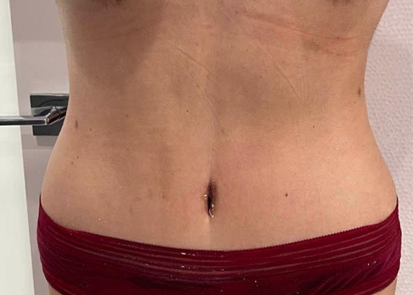 New You Plastic Surgery tummy tuck after — Roslyn, NY